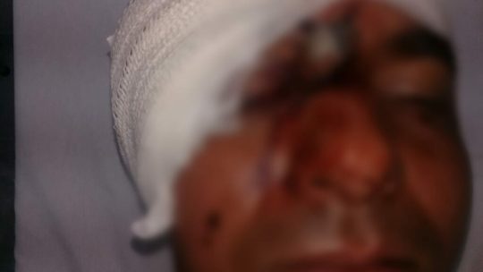 Homem tem faca cravada no rosto após briga com irmão  em Carinhanha
